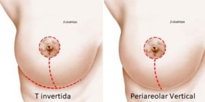levantamiento de senos bucaramanga