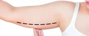 braquioplastia bucaramanga