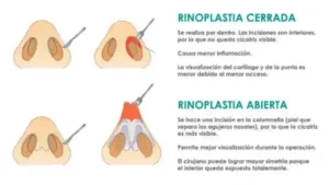 cirugia nasal bucaramanga