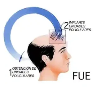 injerto de pelo bucaramanga