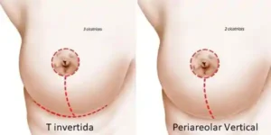 mastopexia bucaramanga