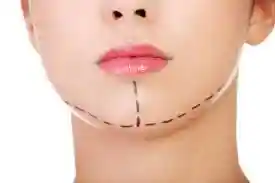 mentoplastia bucaramanga