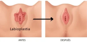 rejuvenecimiento vaginal bucaramanga