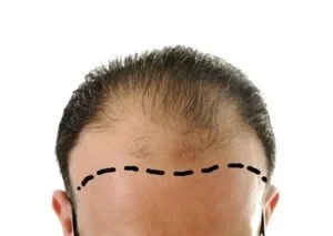 tratamientos capilares