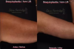 braquioplastia cirugia brazos bucaramanga