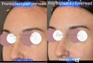 frontoplastia cirugia reduccion frente bucaramanga