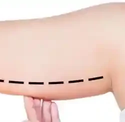 Braquioplastia braquioplastia bucaramanga