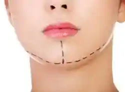 Cirugia de mentón mentoplastia bucaramanga