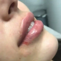 Aumento de labios en Bucaramanga acido hialuronico bucaramanga