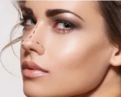 Rinoplastia rinoplastia bucaramanga