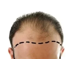 Implante capilar tratamientos capilares